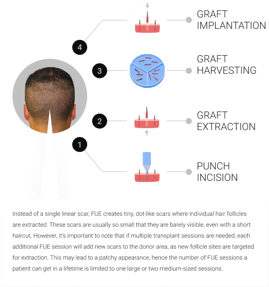 FUE Hair Transplant