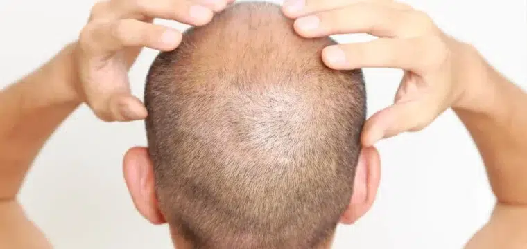 can-a-balding-man-regrow-hair