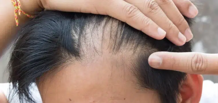 do-i-have-alopecia