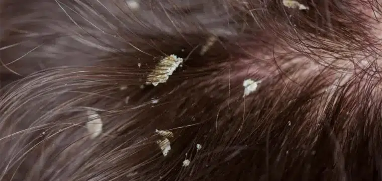 does-dandruff-cause-hair-loss