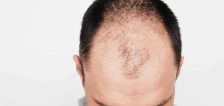 exploring-the-balding-gene