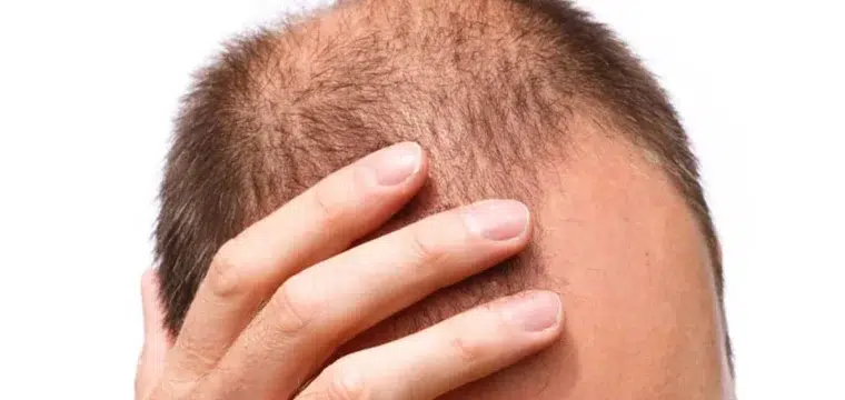key-things-to-know-about-male-pattern-baldness