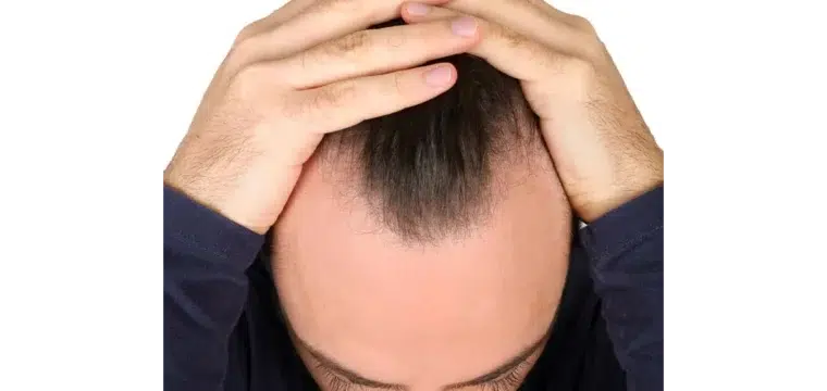 losing-the-battle-against-hair-loss