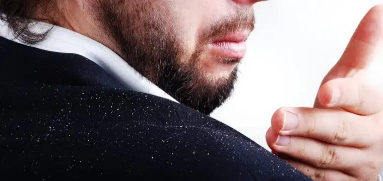seborrheic-dermatitis-cause-hair-loss