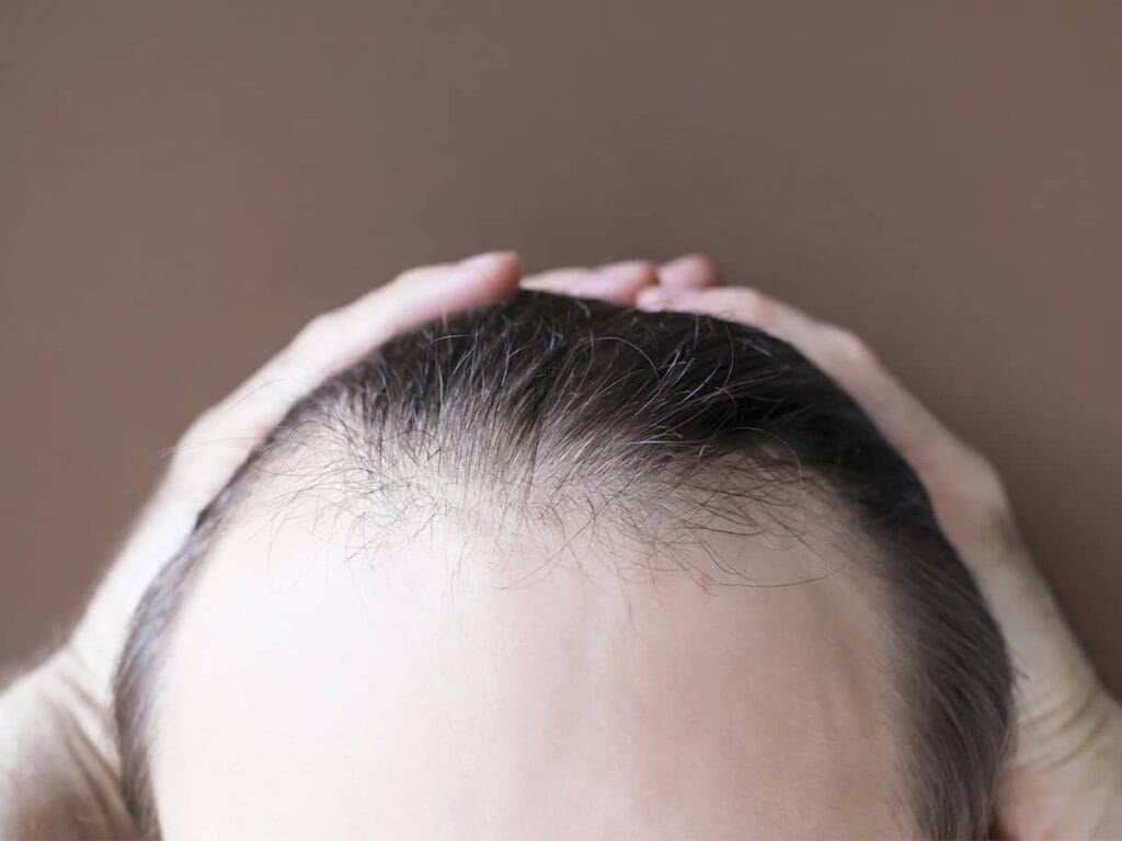 What is Alopecia
