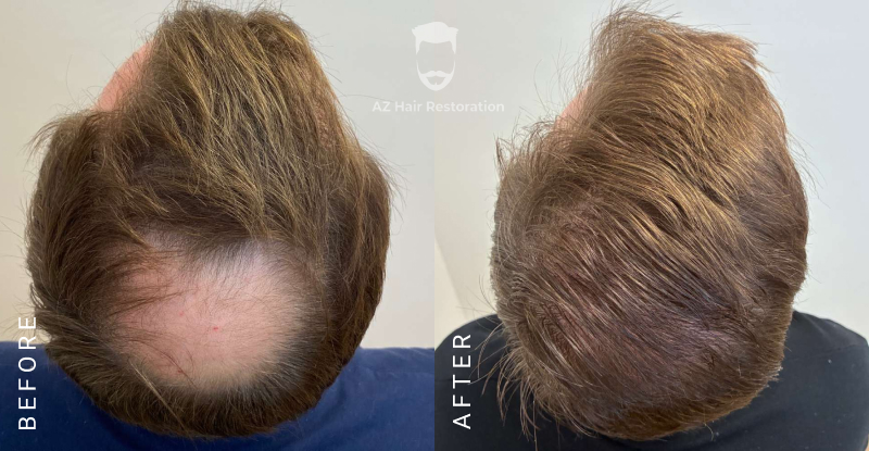 Hair Transplant Before and After