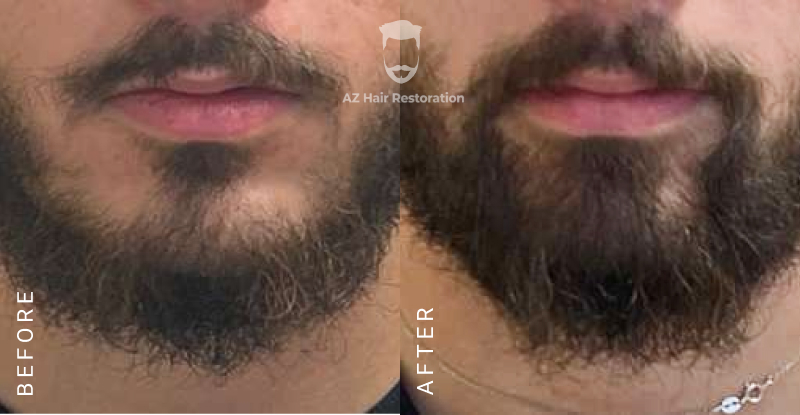 Beard Transplant Before and After