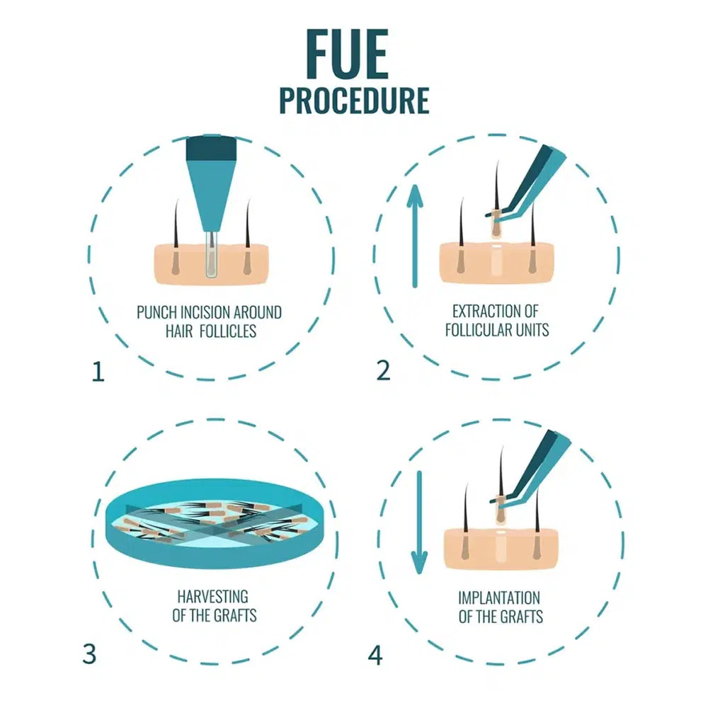FUE procedure