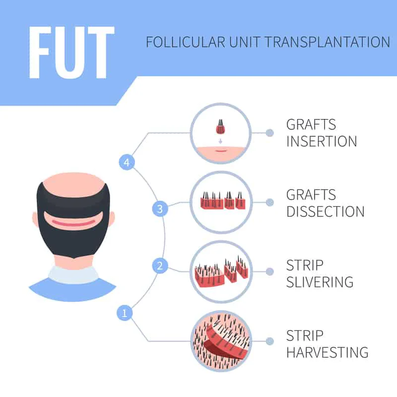 fut hair transplant procedure