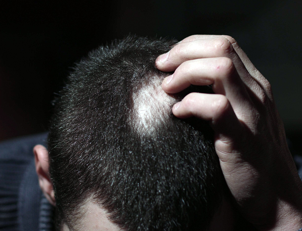 alopecia types and treatment