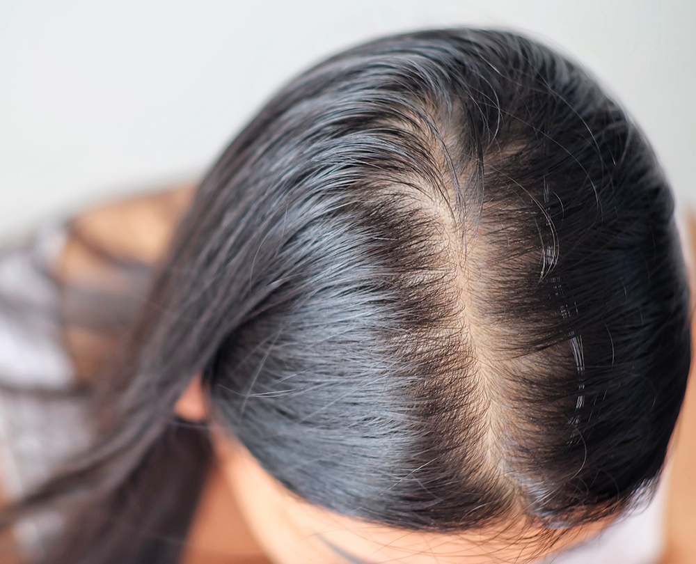 Female Hair Transplant Surgery | Female Pattern Baldness | Permanent Hair Regrowth | Treat Hair Loss In Women | AZ Hair Restoration Raleigh, North Carolina