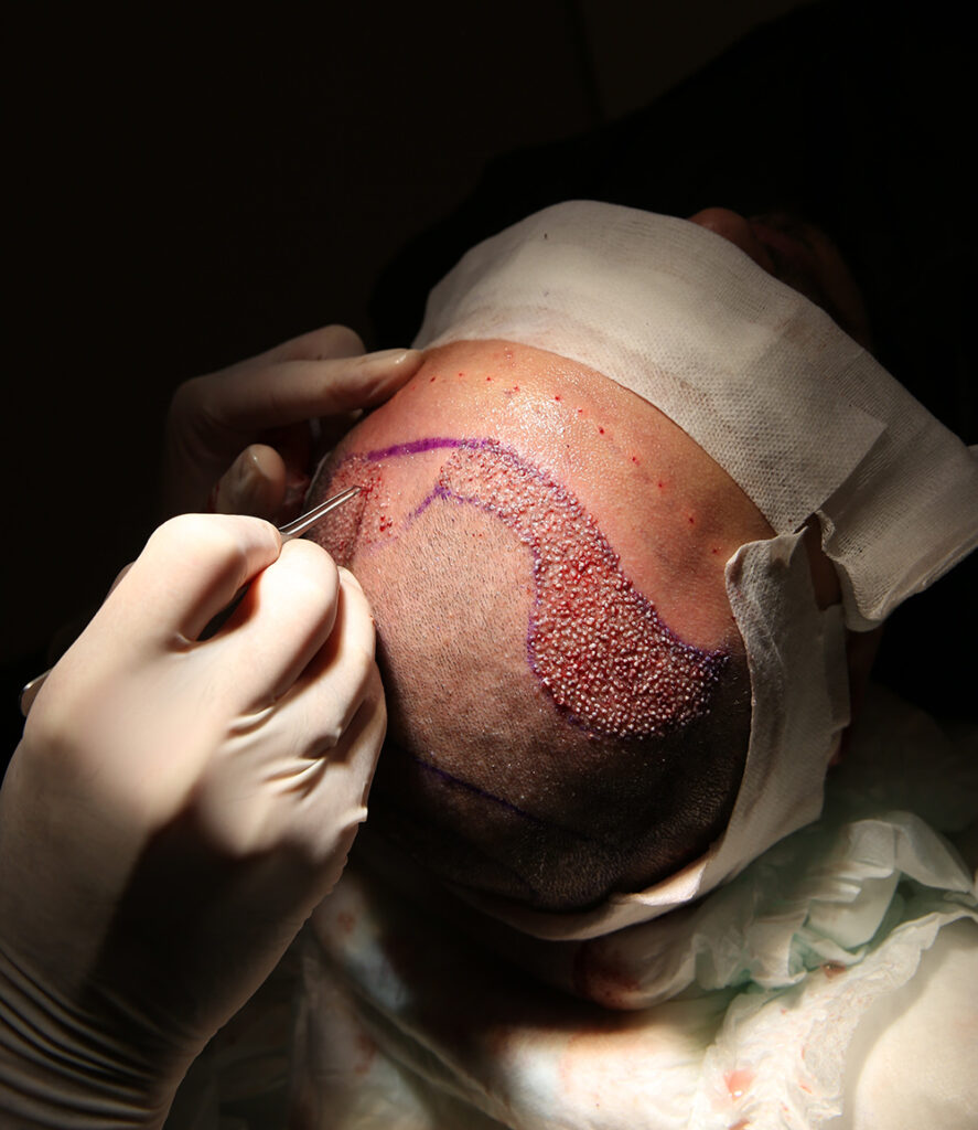 Cost Of FUE Hair Transplant | Follicular Unit Extraction | Affordable Hair Transplantation | FUE Specialist | AZ Hair Restoration Raleigh, North Carolina