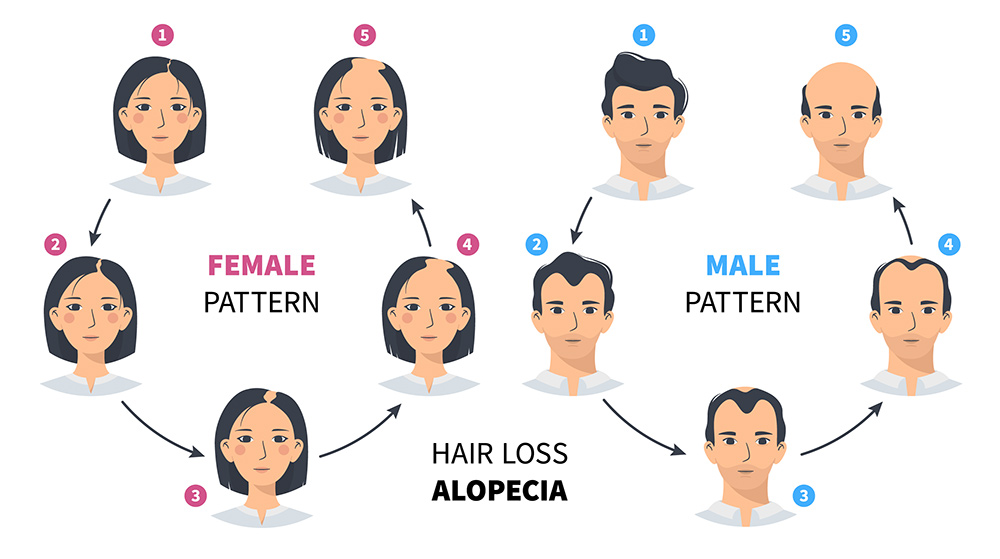 Stages Of Hair Loss | Types Of Hair Loss In Men & Women | How To Regrow Hair | Medical Hair Restoration | Pain Free Non Surgical | AZ Hair Restoration Clinic In Raleigh, NC