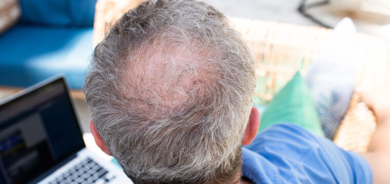 Does Testosterone Cause Hair Loss | Male & Female Pattern Balding | DHT Sensitivity | Hair Restoration Clinic Raleigh, NC