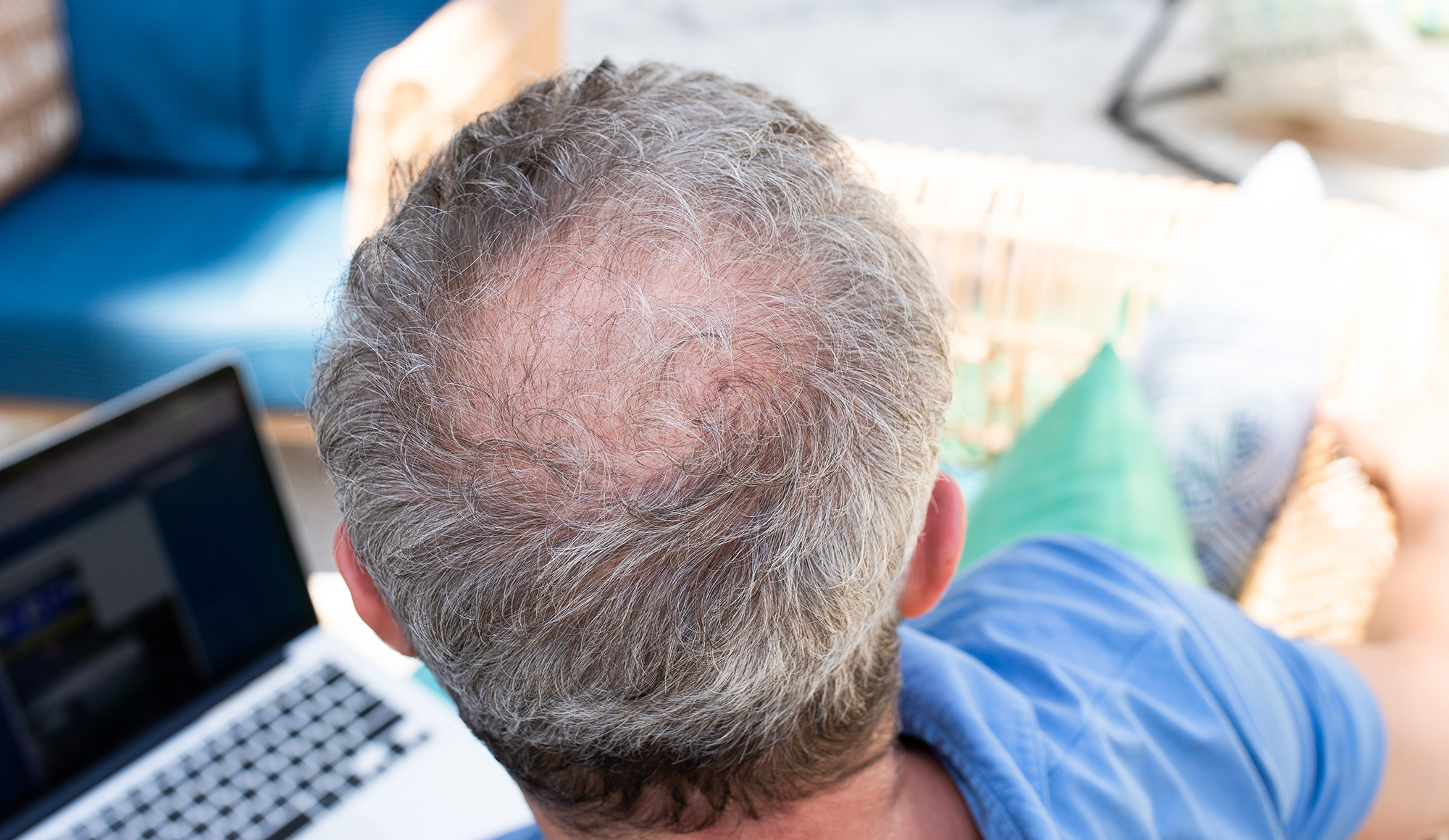 Can Testosterone Levels Lead to Hair Loss? Here’s What Science Says