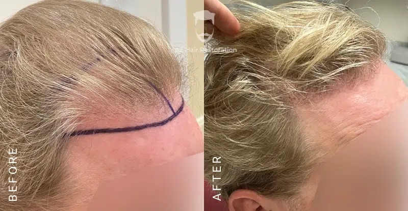 Hair Transplant Surgery Aftercare & Post Op Instructions | Hair Transplantation For Men & Women | Recovery Advice & Timeline For Hair Growth | best Hair Loss Clinic Raleigh, NC | Hair Transplant Surgeon | AZ Hair Restoration