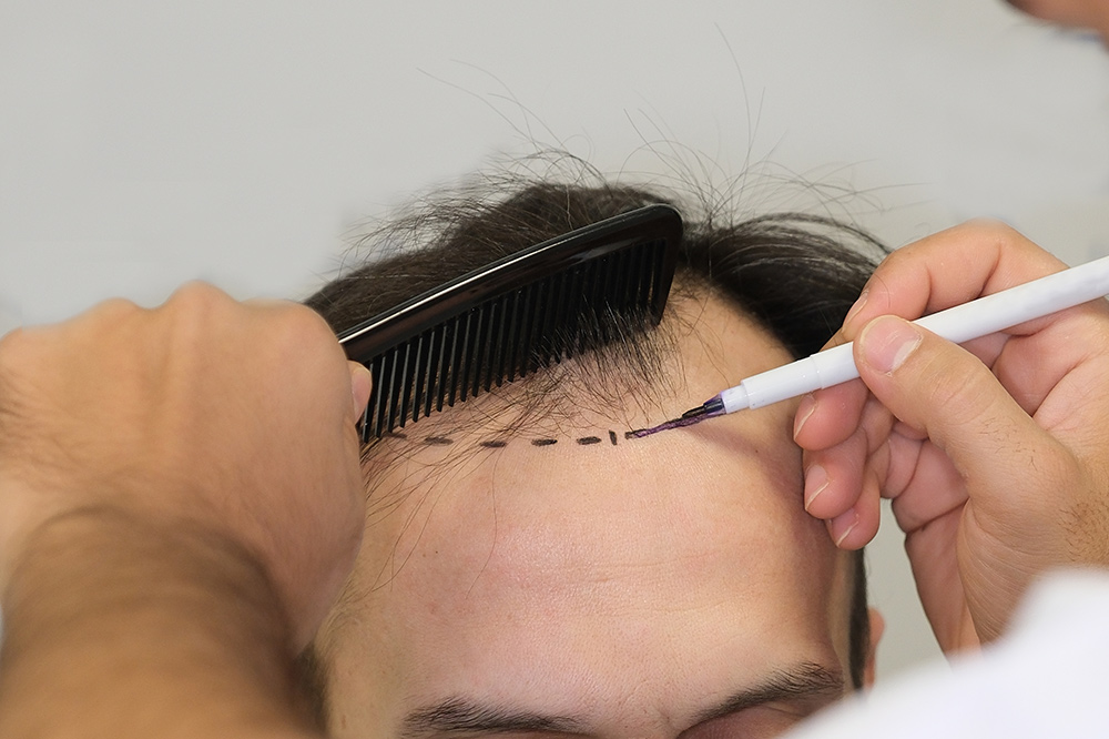 How To Treat Receding Hairline | Best Hair Growth Treatments | Hair Transplant | Hair Loss Clinic | AZ Hair Restoration Rayleigh, North Carolina