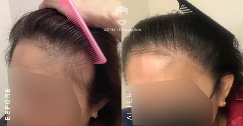 How To Treat Postpartum Hair Loss | Hair Loss In Women | Hormonal Hair Loss | Hair Loss Clinic Rayleigh, North Carolina | AZ Hair Restoration