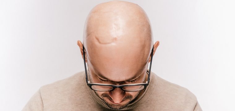 Can Hair Grow On Scars | Hair Transplant On Scar | FUE & FUT Hair Transplant Surgery | AZ Hair Restoration Raleigh North Carolina