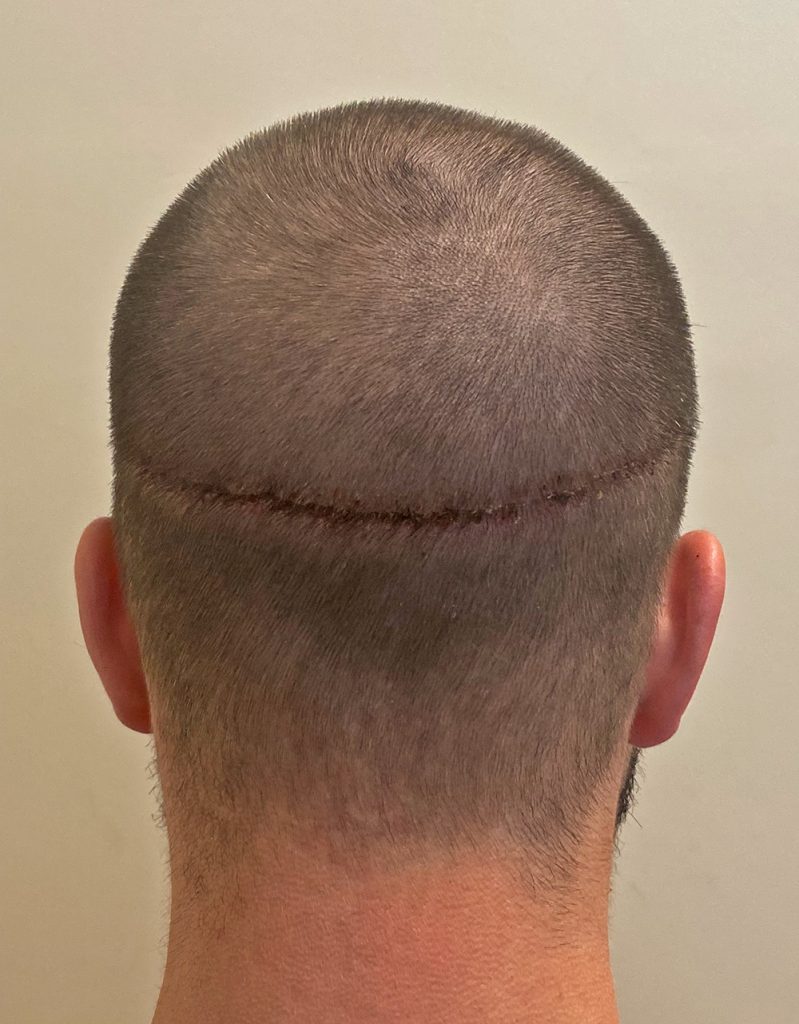 Danny 10 days post surgery