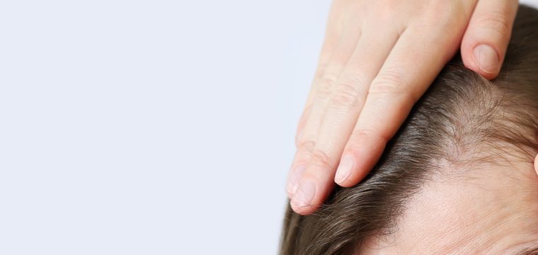 Stages Of Hair Loss | Female & Male Pattern Balding | Causes & Most Effective Treatments | Best Hair Growth Clinic In Raleigh, North Carolina | AZ Hair Restoration