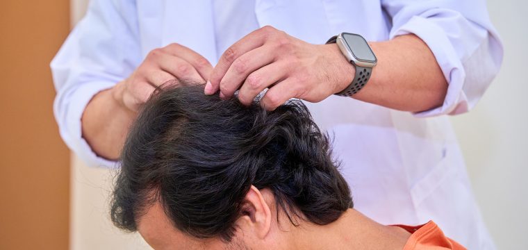 How To Prepare For A Hair Transplant Consultation With A Doctor | Raleigh, NC | AZ Hair Restoration
