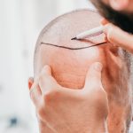 Hair Transplant Financing | Payment Plans With No Interest | How To Pay For Hair Transplant | AZ Hair Restoration Clinic In Raleigh, NC