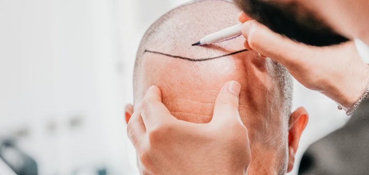 Hair Transplant Financing | Payment Plans With No Interest | How To Pay For Hair Transplant | AZ Hair Restoration Clinic In Raleigh, NC