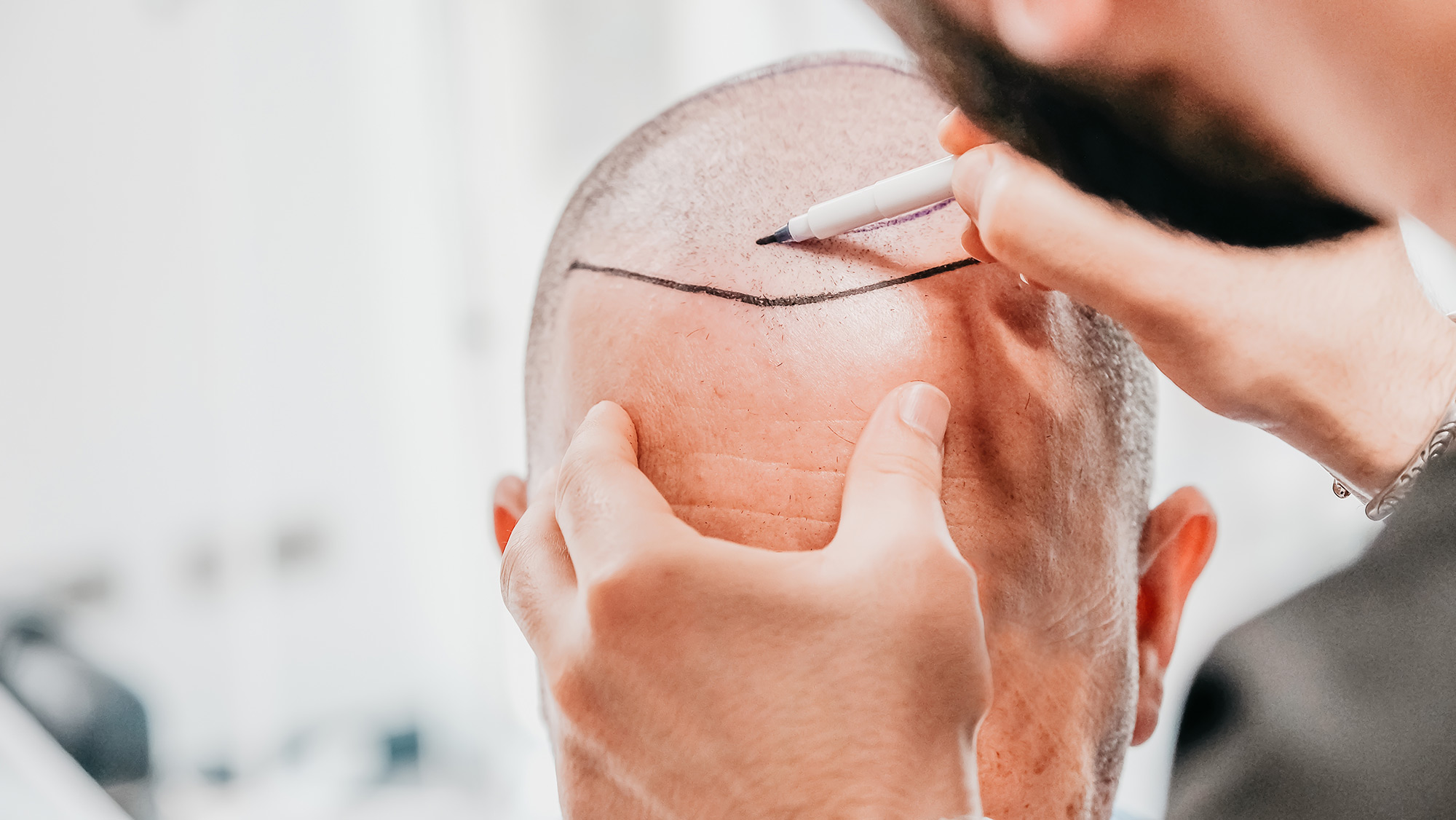 Understanding the Cost of Hair Transplants and Financing Options