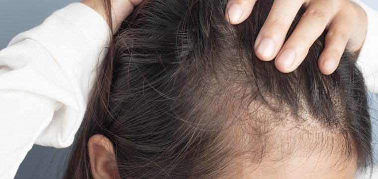 Can Iron Deficiency Cause Hair Loss | Thinning & Shedding | Diet & Nutrition For Hair Growth | Medical Treatments | AZ Hair Restoration Raleigh, NC