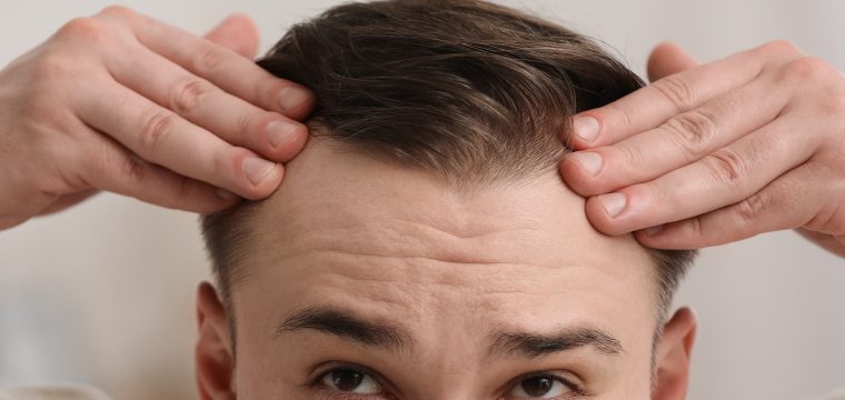 Mature Hairline VS Receding Hairline | Genetic Baldness | Male & Female Hair Loss | AZ Hair Restoration In Raleigh, NC
