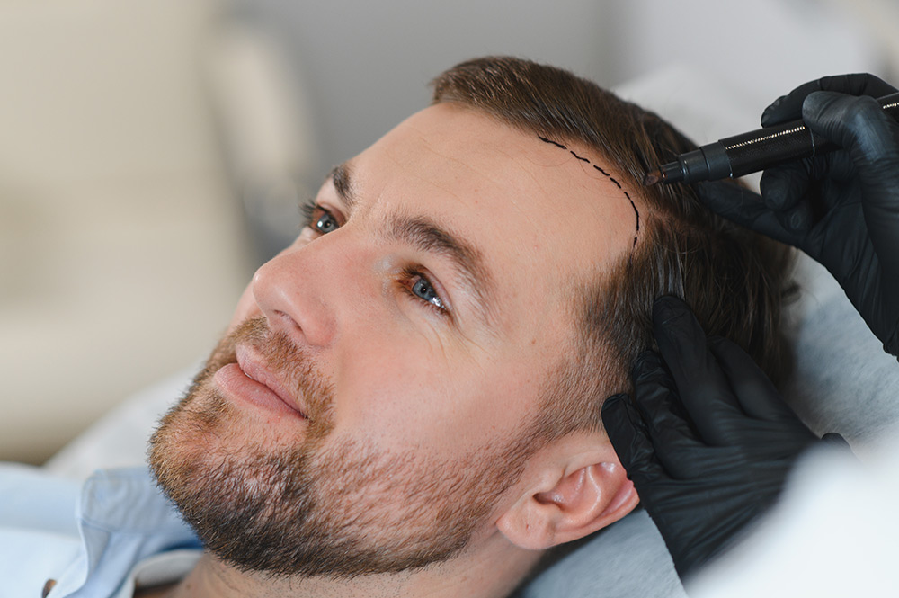 Book A Free Hair Transplant Consultation With A Doctor | FUE & FUT Hair Transplantation For Men & Women | Raleigh, NC | AZ Hair Restoration